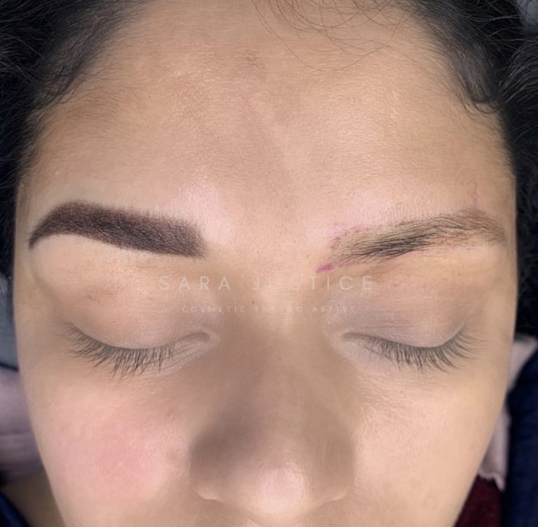 eyebrow damage that needs to be repaired