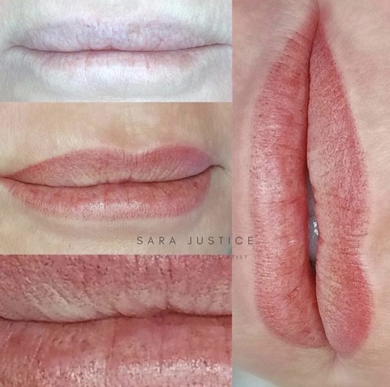 lip transformation