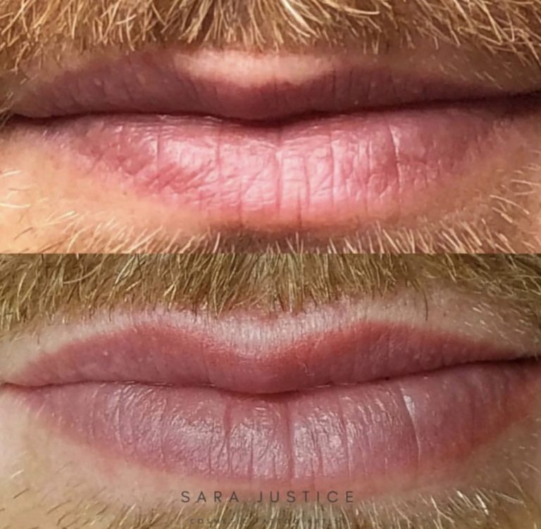 Man's lip restoration