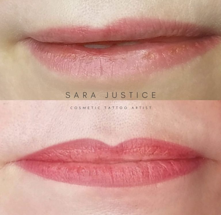 lip restoration example