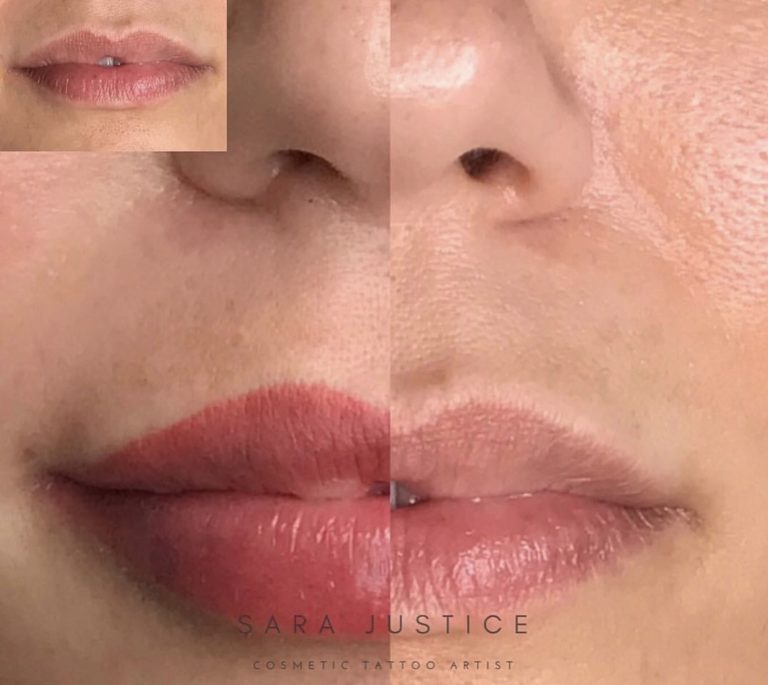 lips before and after