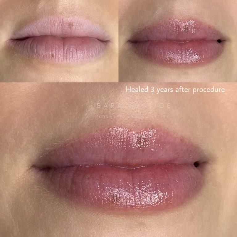Healed lip tattoo three years after the procedure
