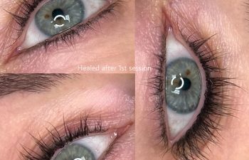 Close-up images of a blue-gray eye with long lashes, showing different angles of the upper and lower eyelid, labeled "Healed after 1st session.