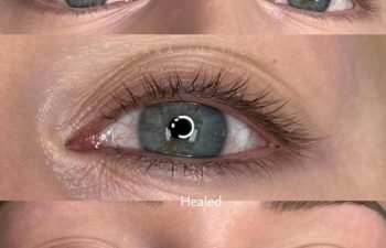 Close-up images show an eye before, immediately after, and healed following a cosmetic procedure, highlighting differences in eyelash and skin appearance.