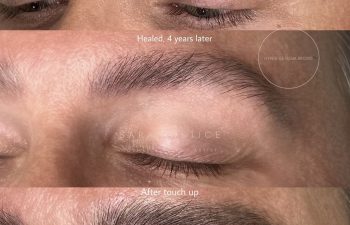 Three close-up images of an eyebrow show progression: sparse brows before treatment, fuller healed brows after 4 years, and enhanced definition after a touch-up.
