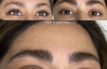 Close-up comparison of a woman’s eyebrows before and three years after a cosmetic procedure, showing fuller and more defined brows in the after images.