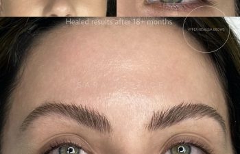 Close-up of a woman's eyebrows before and after hyper-realism brow treatment, showing healed results after 18+ months.