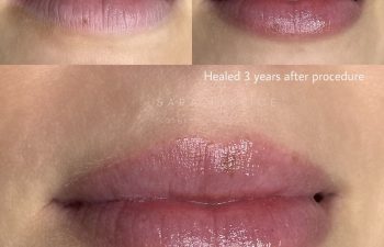 Three close-up images of lips show progression before and after a cosmetic lip procedure, with healed results displayed three years post-procedure.