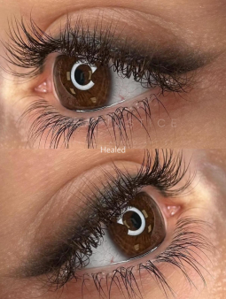Close-up comparison of a brown eye with eyelash extensions or lifted lashes; the top shows the initial result, the bottom shows the healed appearance.