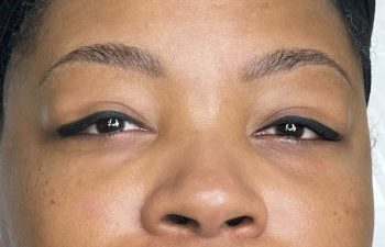 Close-up of a woman's face showing healed eyebrows after a cosmetic procedure, with a small inset image labeled "before" showing her natural eyebrows for comparison.
