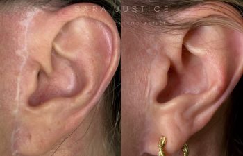 Side-by-side comparison of an ear with a visible scar before treatment and the same ear after one session with the scar significantly less noticeable.
