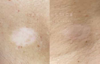 Close-up of skin showing a white spot before treatment on the left and a more even skin tone after healing on the right. Text on image indicates a cosmetic tattoo artist provided the service.