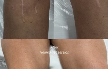 Side-by-side comparison of knees shows visible scars before and reduced appearance of scars after one healed cosmetic tattoo session.
