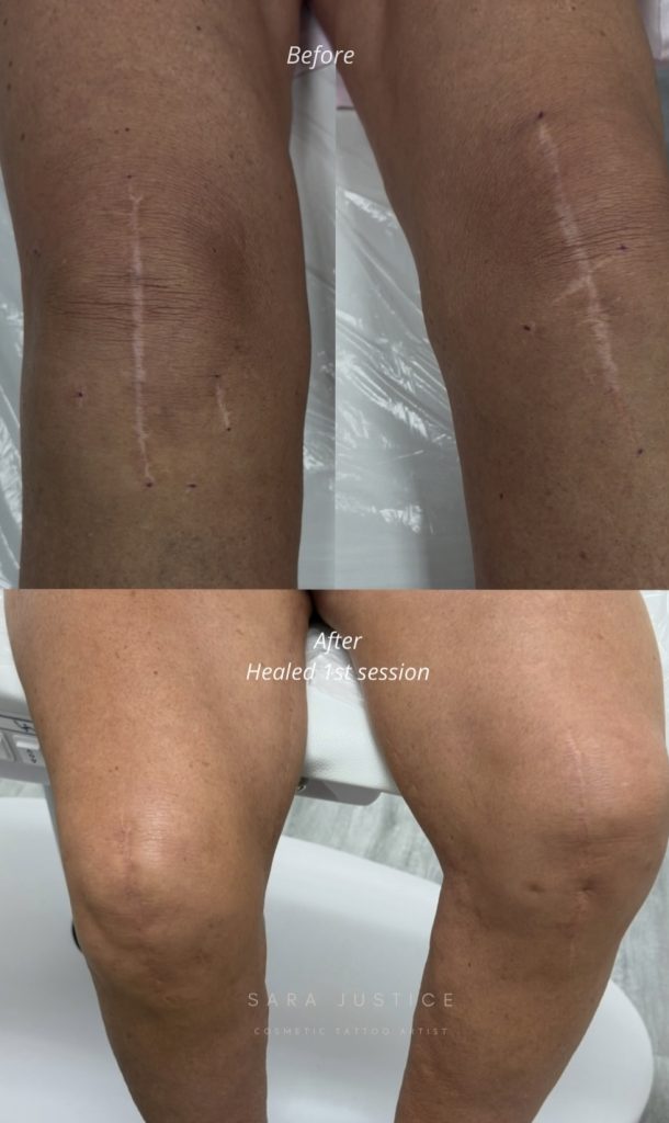 Side-by-side comparison of knees shows visible scars before and reduced appearance of scars after one healed cosmetic tattoo session.
