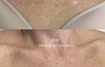 Before and after comparison of a person's chest showing reduced white spots and more even skin tone following a cosmetic tattoo session.