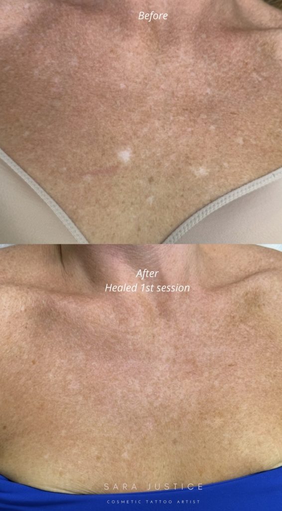 Before and after comparison of a person's chest showing reduced white spots and more even skin tone following a cosmetic tattoo session.